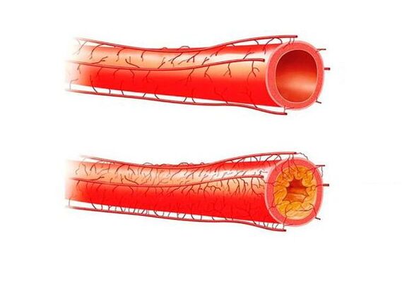 Potency problems due to blood vessels